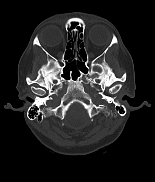 File:Cerebellar metastases - colorectal adenocarcinoma (Radiopaedia 40947-43652 AX Bone C- 2.0 MPR 6).png