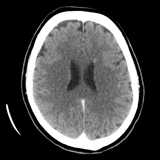Cerebellar metastasis (cystic appearance) (Radiopaedia 41395-44258 B 32).png