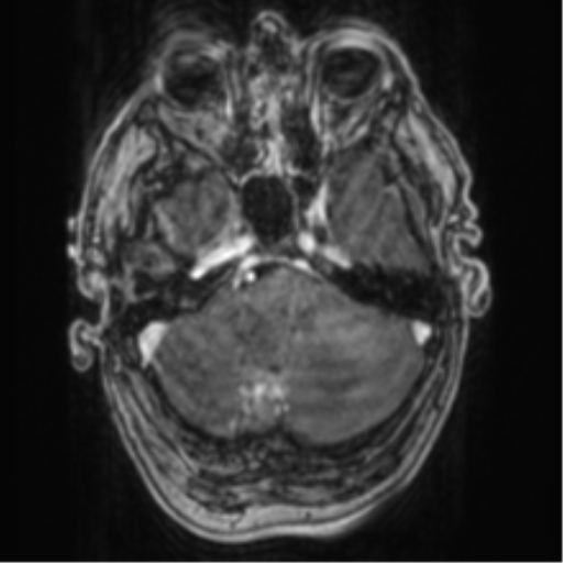 Cerebellar metastasis from lung adenocarcinoma (Radiopaedia 86690-102829 Axial T1 C+ 20).png