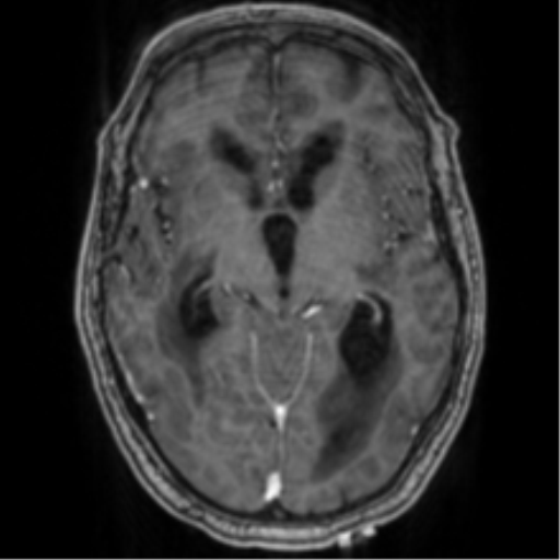 Cerebellar metastasis from lung adenocarcinoma (Radiopaedia 86690-102829 Axial T1 C+ 38).png