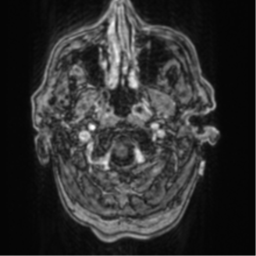 Cerebellar metastasis from lung adenocarcinoma (Radiopaedia 86690-102829 Axial T1 C+ 8).png