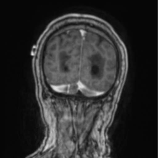 File:Cerebellar metastasis from lung adenocarcinoma (Radiopaedia 86690-102829 Coronal T1 C+ 15).png
