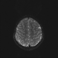 File:Cerebellar stroke (Radiopaedia 32202-33150 Axial DWI 19).png