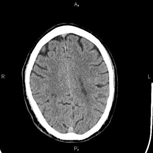 File:Cerebellopontine angle arachnoid cyst (Radiopaedia 85149-100704 Axial With contrast 35).jpg