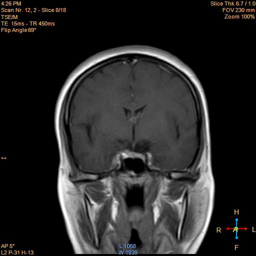 File:Cerebellopontine angle meningioma (Radiopaedia 22488-22525 Coronal T1 C+ 8).jpg