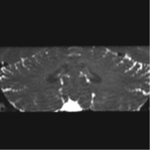 Cerebellopontine angle meningioma (Radiopaedia 48434-53348 Coronal T2 19).png
