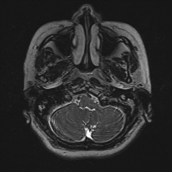 Cerebellopontine angle meningioma (Radiopaedia 53561-59591 Axial 3D volume T2 26).jpg