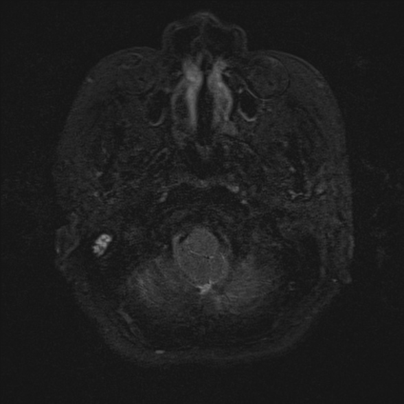 Cerebellopontine angle meningioma (Radiopaedia 53561-59591 Axial 3D volume T2 6).jpg