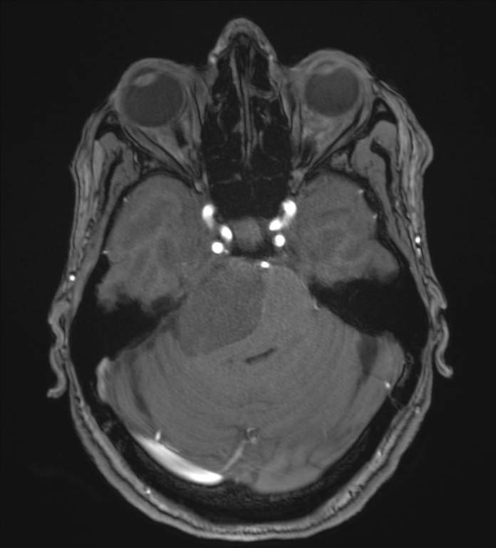 Cerebellopontine angle meningioma (Radiopaedia 72983-83680 Axial MRA 35).jpg