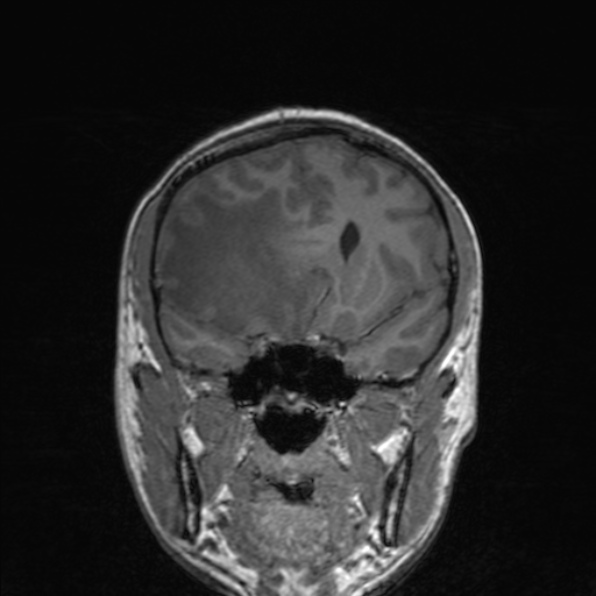 Cerebral abscess (Radiopaedia 24212-24478 Coronal T1 86).jpg