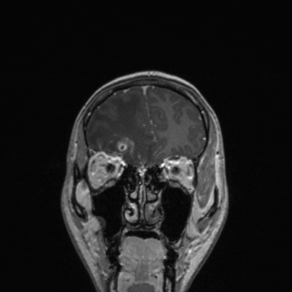 Cerebral abscess (Radiopaedia 24212-24478 Coronal T1 C+ 55).jpg