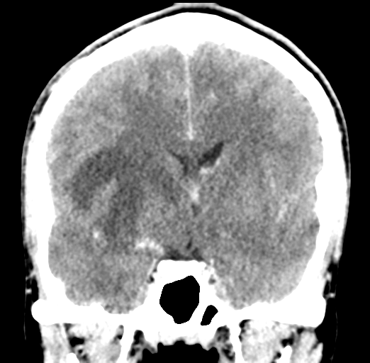 Cerebral abscess (Radiopaedia 60342-68008 Coronal C+ delayed 31).png