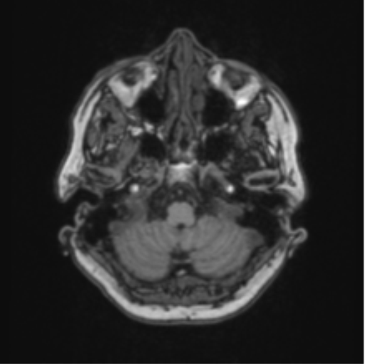 Cerebral abscess from pulmonary arteriovenous malformation (Radiopaedia 86275-102291 Axial T1 15).png