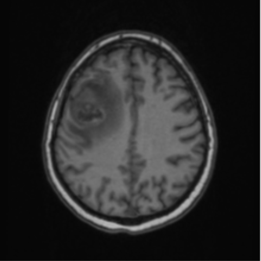 Cerebral abscess from pulmonary arteriovenous malformation (Radiopaedia 86275-102291 Axial T1 52).png