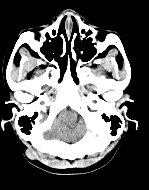 Cerebral abscesses (Radiopaedia 70458-80568 Axial non-contrast 14).jpg