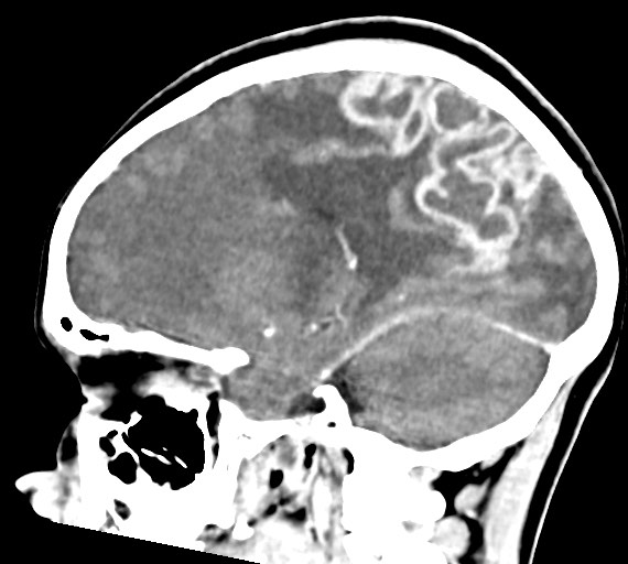 Cerebral abscesses (Radiopaedia 70458-80568 Sagittal Contrast 24).jpg