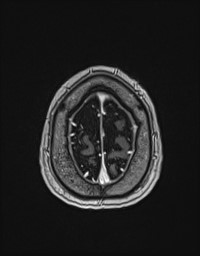 Cerebral amyloid angiopathy-related inflammation (Radiopaedia 58270-65377 Axial T1 C+ fat sat 139).jpg