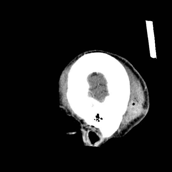 Cerebral amyloid angiopathy-related inflammation (Radiopaedia 74836-85848 C 56).jpg