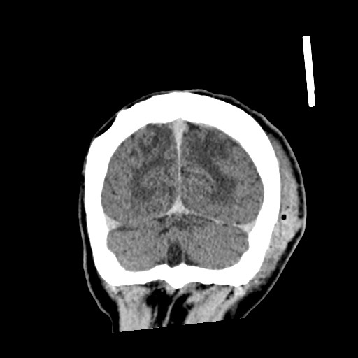 Cerebral amyloid angiopathy-related inflammation (Radiopaedia 74836-85848 Coronal non-contrast 62).jpg