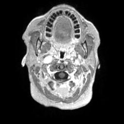 Cerebral amyloid angiopathy (Radiopaedia 29129-29518 Axial T1 C+ 6).jpg