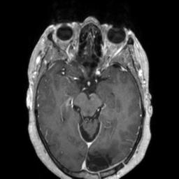Cerebral amyloid angiopathy (Radiopaedia 29129-29518 Axial T1 C+ 62).jpg
