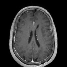 Cerebral amyloid angiopathy (Radiopaedia 29129-29518 Axial T1 C+ 93).jpg