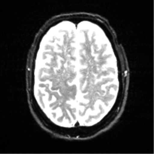 Cerebral amyloid angiopathy (Radiopaedia 46082-50433 Axial DWI 20).png