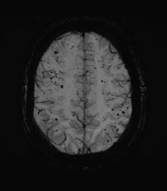 Cerebral amyloid angiopathy (Radiopaedia 46082-50433 Axial SWI MIP 60).png