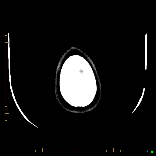 Cerebral arteriovenous malformation (AVM) (Radiopaedia 78162-90706 Axial non-contrast 63).jpg