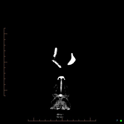 Cerebral arteriovenous malformation (AVM) (Radiopaedia 78162-90706 Coronal non-contrast 4).jpg