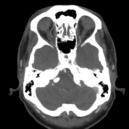 Cerebral arteriovenous malformation (Radiopaedia 39259-41505 AX CEREBRAL CTA 13).png