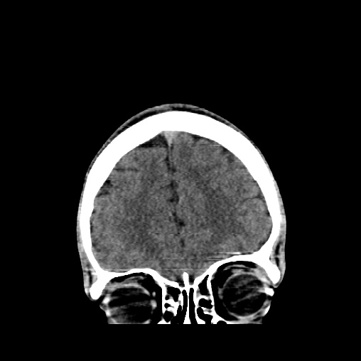 Cerebral arteriovenous malformation (Radiopaedia 61964-70028 Coronal non-contrast 12).jpg