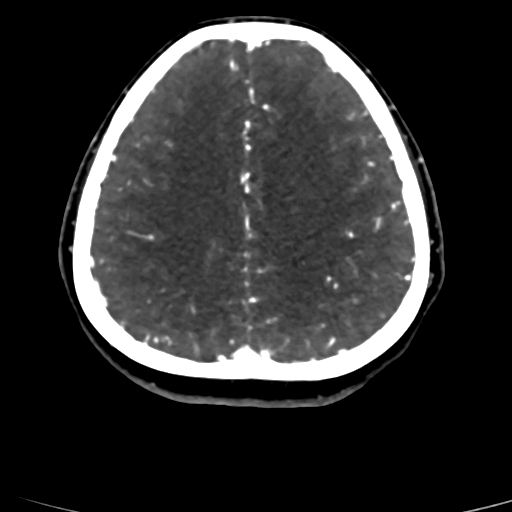 Cerebral arteriovenous malformation (Radiopaedia 73830-84645 Axial C+ delayed 25).jpg