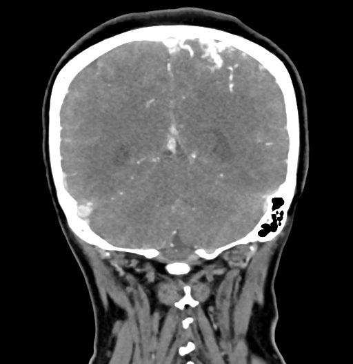 Cerebral arteriovenous malformation (Radiopaedia 73830-84645 C 72).jpg
