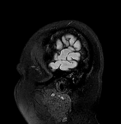 Cerebral arteriovenous malformation (Radiopaedia 74411-85746 Sagittal FLAIR 4).jpg