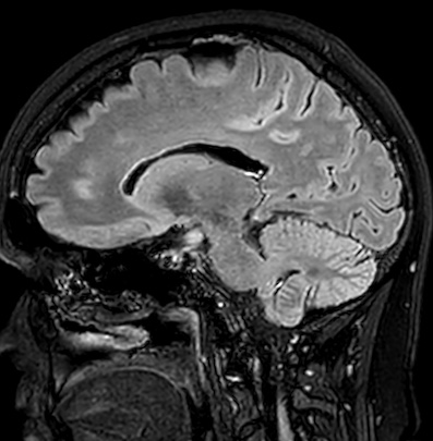 Cerebral arteriovenous malformation (Radiopaedia 74411-85746 Sagittal FLAIR 47).jpg