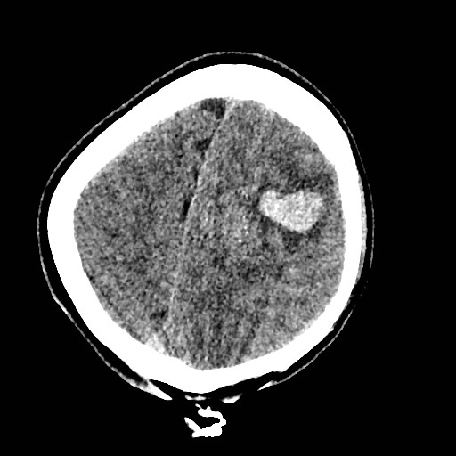 Cerebral arteriovenous malformation (Radiopaedia 79677-92887 Axial non-contrast 38).jpg
