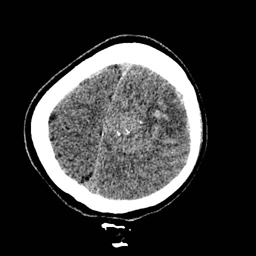 Cerebral arteriovenous malformation (Radiopaedia 79677-92887 Axial non-contrast 45).jpg