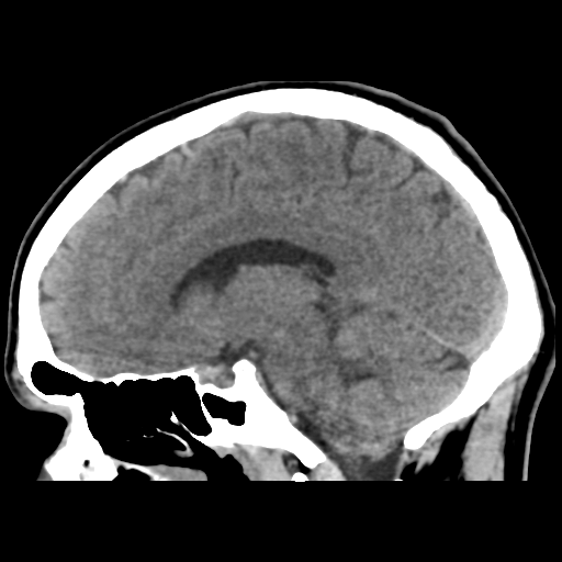 File:Cerebral arteriovenous malformation (Spetzler-Martin grade 2) (Radiopaedia 41262-44076 A 30).png