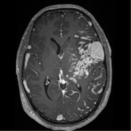 Cerebral arteriovenous malformation - huge (Radiopaedia 35734-37272 Axial T1 C+ 36).png