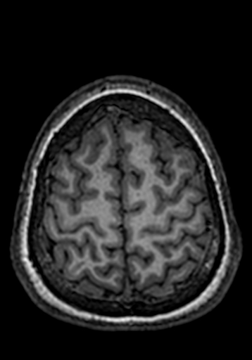 Cerebral arteriovenous malformation at posterior body of corpus callosum (Radiopaedia 74111-84925 Axial T1 36).jpg