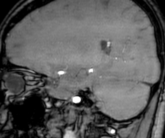 File:Cerebral arteriovenous malformation at posterior body of corpus callosum (Radiopaedia 74111-84925 J 124).jpg