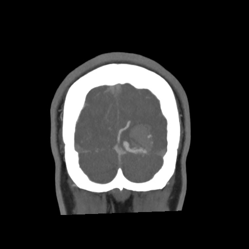 Cerebral arteriovenous malformation with lobar hemorrhage (Radiopaedia 35598-57216 C 84).jpg