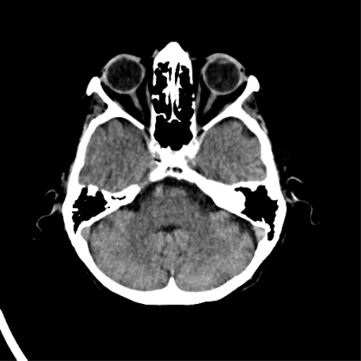 File:Cerebral arteriovenous malformation with lobar hemorrhage (Radiopaedia 44725-48510 Axial non-contrast 14).png