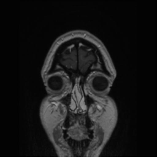 Cerebral cavernoma and development venous anomaly (Radiopaedia 37603-39482 Coronal T1 C+ 87).png