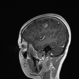 Cerebral cavernous venous malformation (Radiopaedia 70008-80021 Sagittal T1 C+ 15).jpg