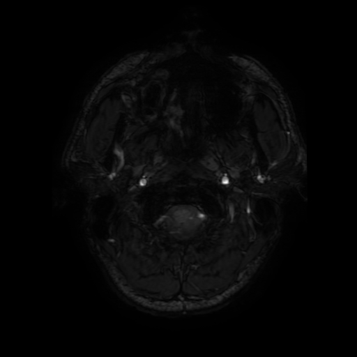 File:Cerebral cavernous venous malformation (Zabramski type II) (Radiopaedia 85511-101198 Axial SWI 7).jpg
