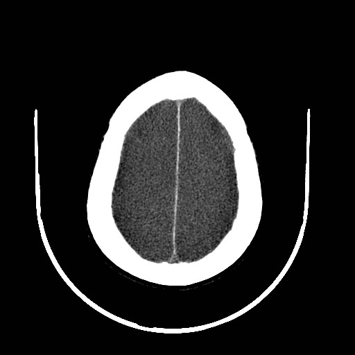 Cerebral edema (evolution in time) (Radiopaedia 19418-19439 non-contrast 77).jpg