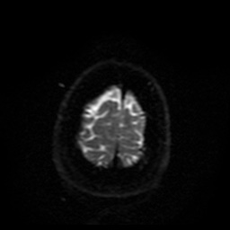 File:Cerebral embolic infarcts (embolic shower) (Radiopaedia 49837-55108 Axial DWI 4).jpg