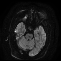 File:Cerebral embolic infarcts (embolic shower) (Radiopaedia 49837-55108 Axial DWI 81).jpg